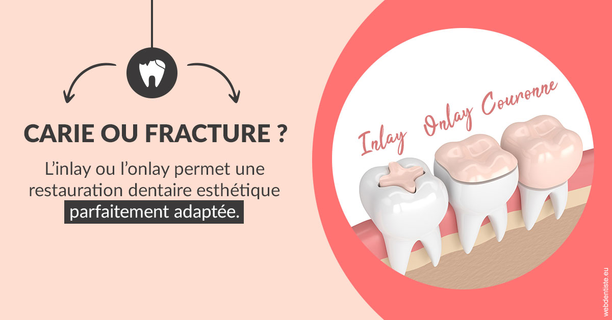 https://dr-hayat-carine.chirurgiens-dentistes.fr/T2 2023 - Carie ou fracture 2
