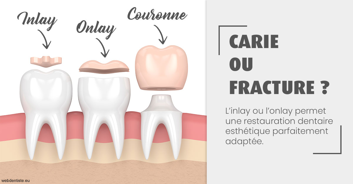 https://dr-hayat-carine.chirurgiens-dentistes.fr/T2 2023 - Carie ou fracture 1
