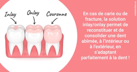 https://dr-hayat-carine.chirurgiens-dentistes.fr/L'INLAY ou l'ONLAY 2
