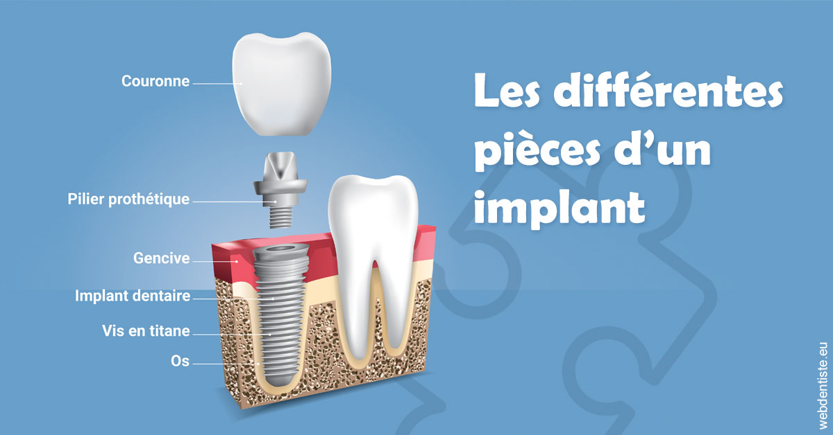 https://dr-hayat-carine.chirurgiens-dentistes.fr/Les différentes pièces d’un implant 1